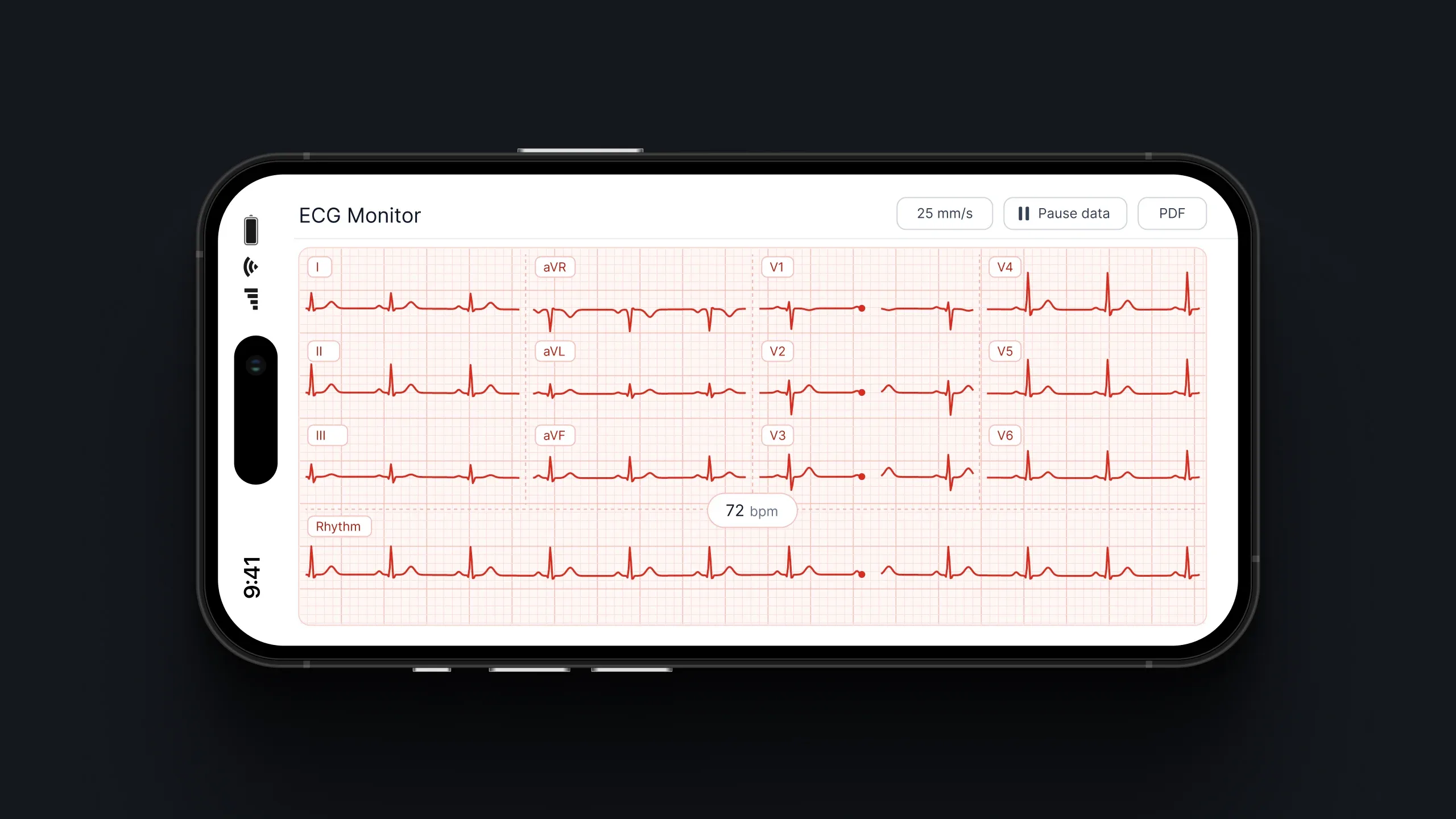 Close-up of a smartphone displaying multi-lead ECG readings, heart rate, and monitoring controls.