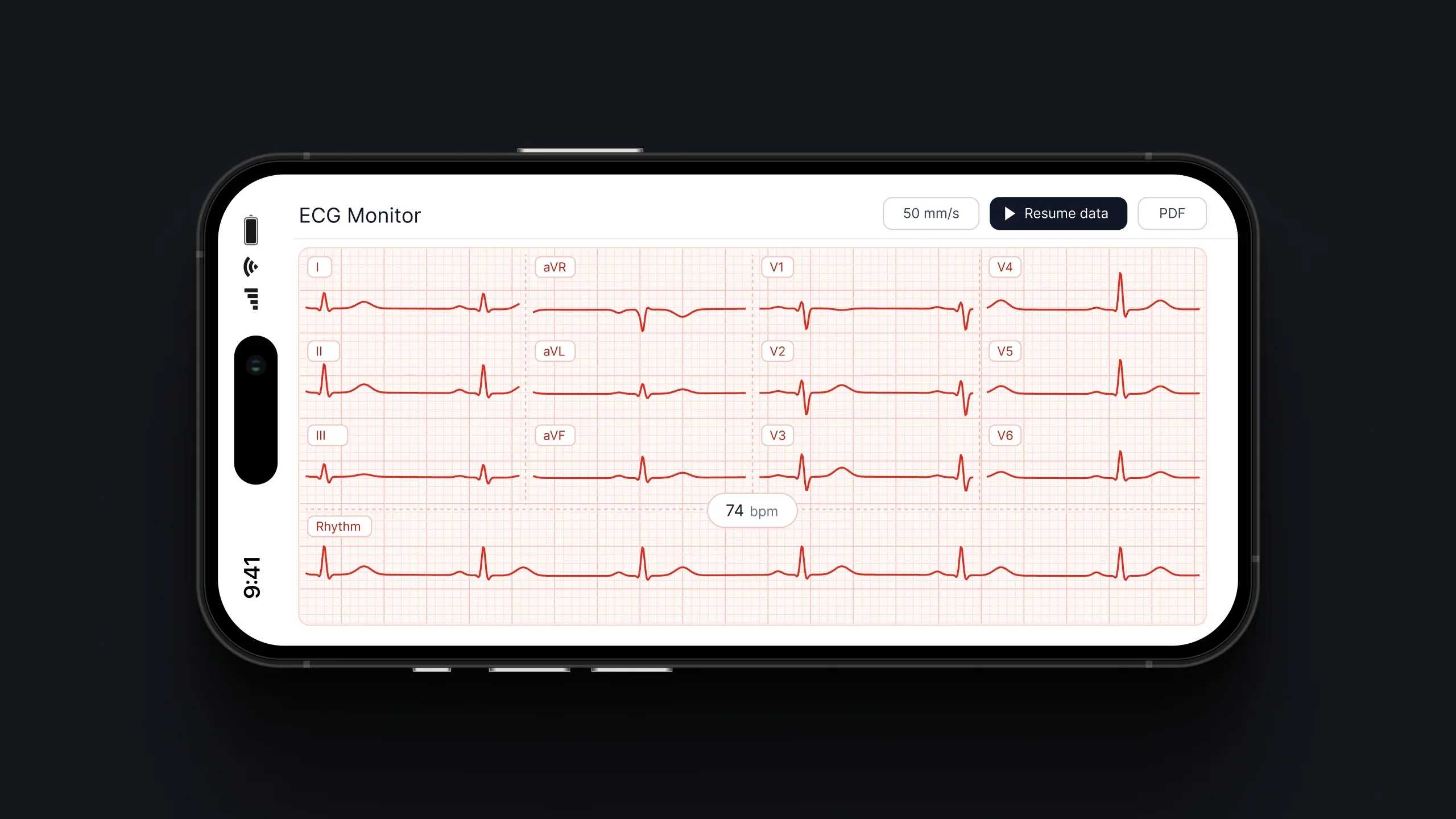 A smartphone ECG monitor displays heart rhythm waveforms at 74 bpm with data paused.