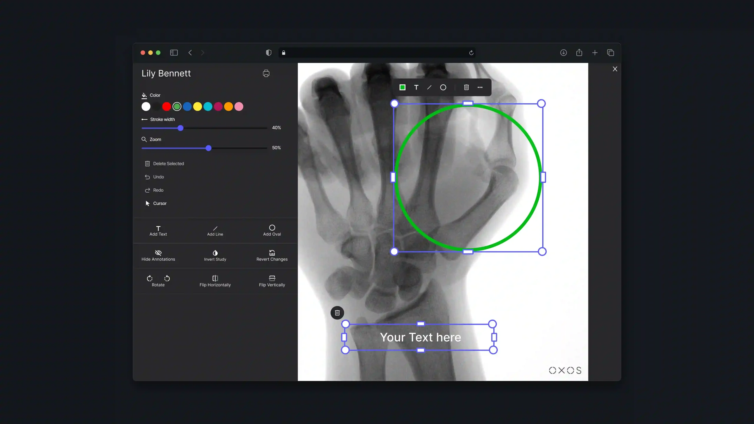 X-ray annotation editor with drawing tools, a selected region, and a text label on a hand image.