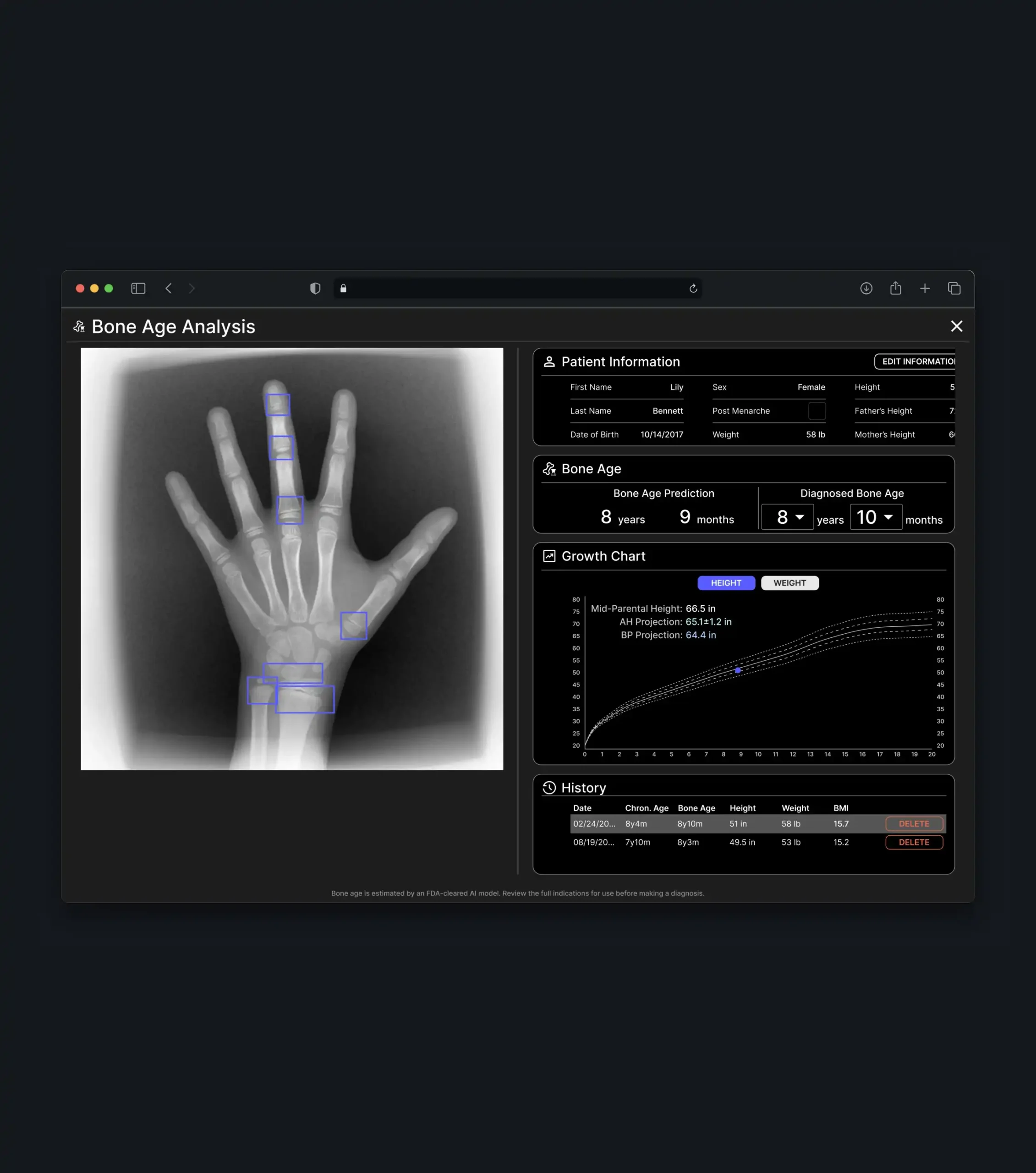 Bone age analysis screen with a hand X-ray, measurement markers, age results, and a growth chart.